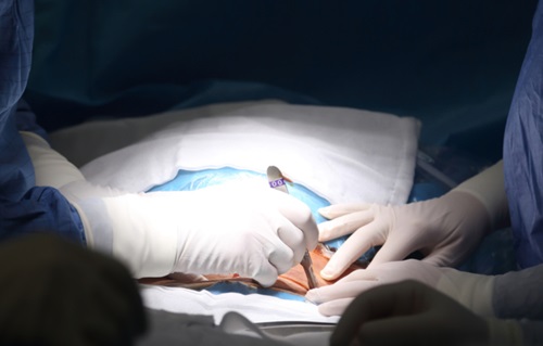 Laparoscopic Inguinal Hernia Repair (Keyhole Surgery) - The British Hernia  Centre