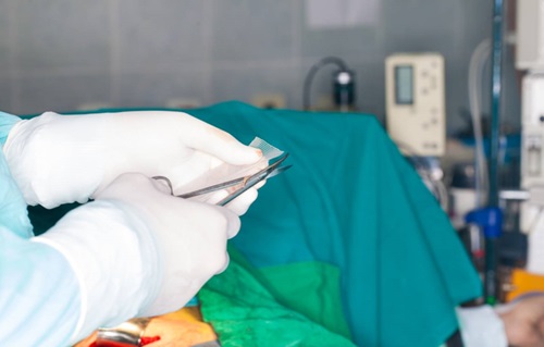 Laparoscopic Inguinal Hernia Repair (Keyhole Surgery) - The British Hernia  Centre